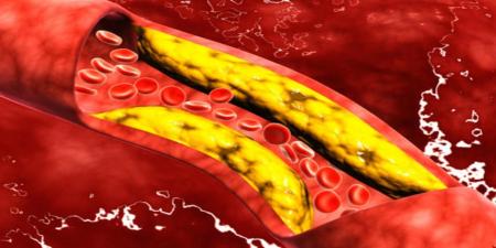 7 عادات يومية لخفض مستويات الكوليسترول بشكل طبيعي - عرب بريس