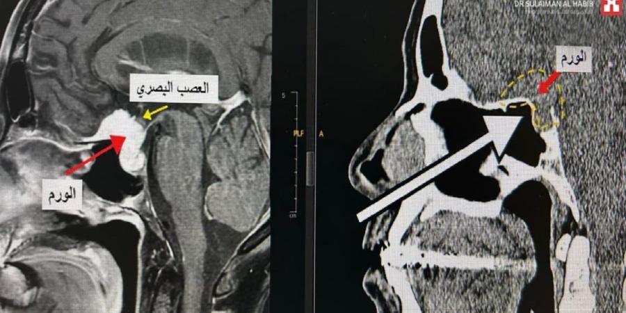 مستشفى الدكتور سليمان الحبيب بالفيحاء في جدة يُنهي معاناة ستينية مع ورم دماغي بقاع الجمجمة - عرب بريس